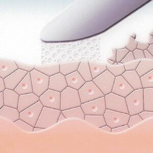 Microdermabrasion